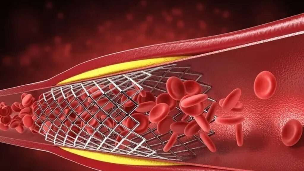 Madrid destina 40 millones a stents coronarios para mejorar el tratamiento de enfermedades cardiovasculares