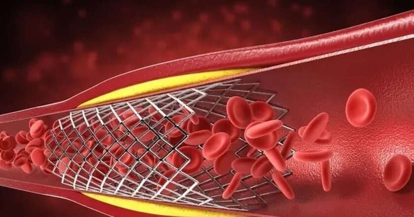 Madrid destina 40 millones a stents coronarios para mejorar el tratamiento de enfermedades cardiovasculares